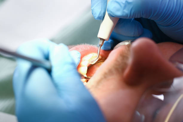 Best Emergency Root Canal Treatment in Richwood, TX