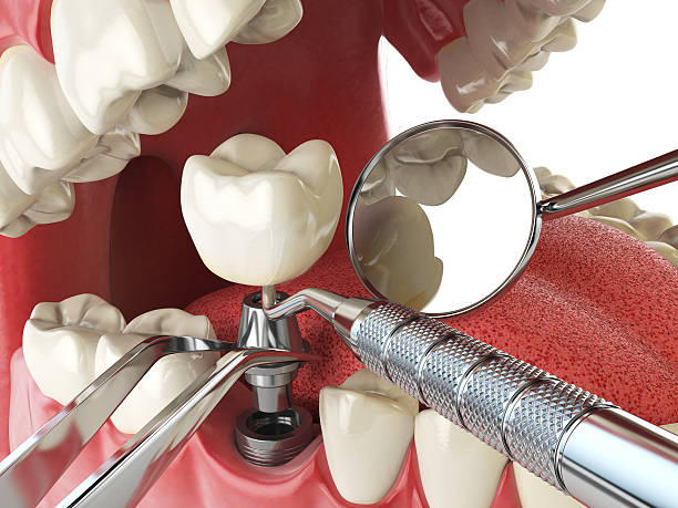 Best Emergency Tooth Extraction in Richwood, TX